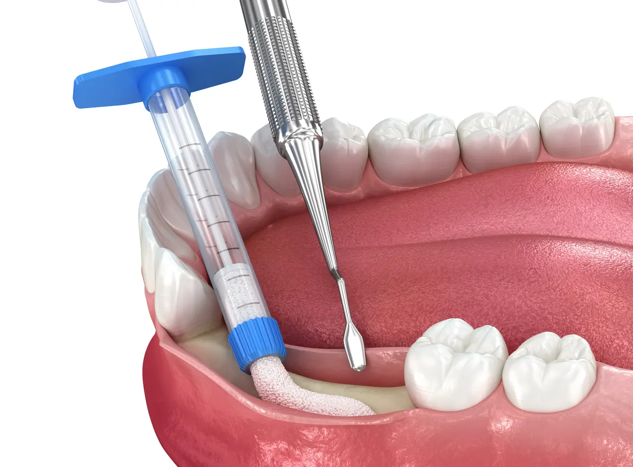 Bone Grafting