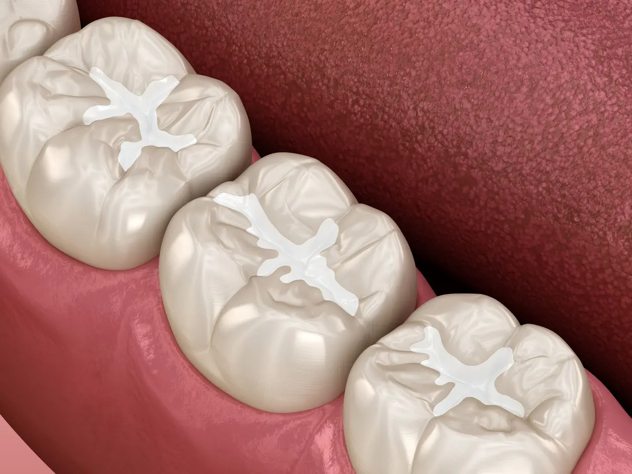 Dental Fillings