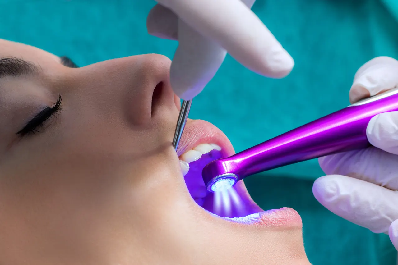 Dental Sealants