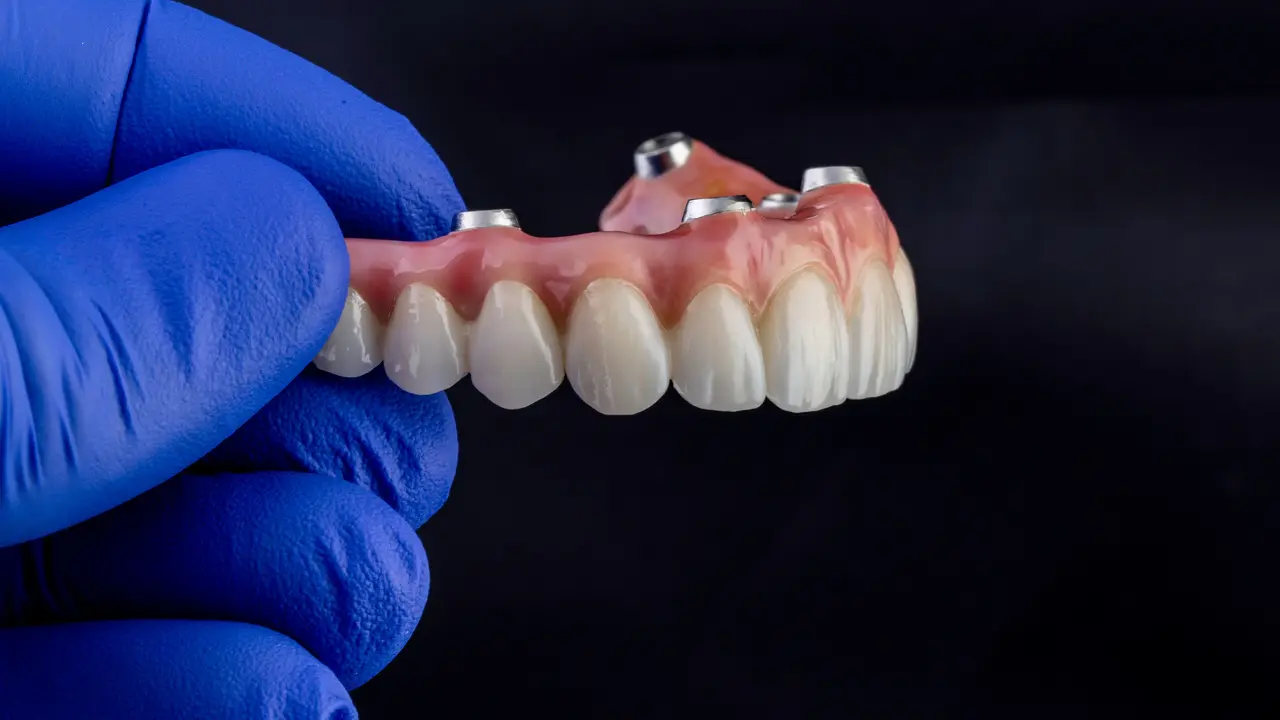 Implant Overdentures
