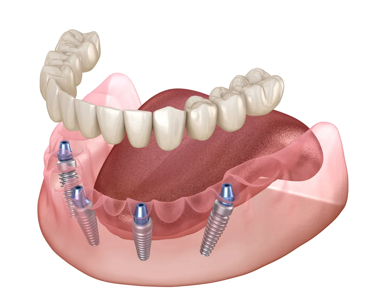 Implant Supported Dentures