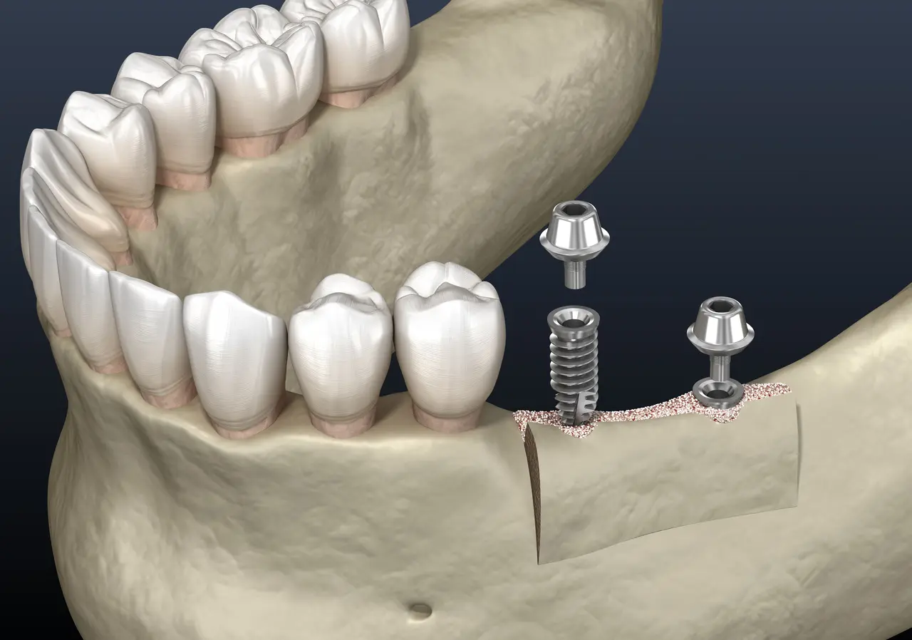 Ridge Augmentation