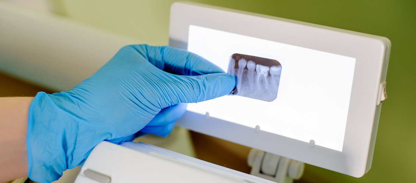 Dentist holding up x-ray examining teethes root canals.
